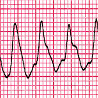 Electrical Storm and Incessant Ventricular Tachycardia