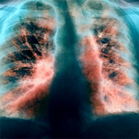 excess-ventilation-in-copd-heart-failure-overlap