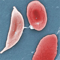 FDA Approves New Pill to Treat Sickle Cell Disease