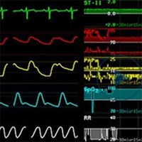 Hemodynamic Monitoring – The Why, When, Which and What