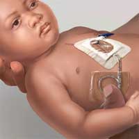 Holding and Mobility of Pediatric Patients With Transthoracic Intracardiac Catheters