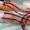 How I Manage Drainage Insufficiency on ECMO