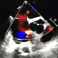 Iatrogenic Hypoxemia and Atrial Septal Defect Due to Electrical Storm Ablation After Left Ventricular Assist Device