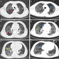 Imaging Changes of Severe COVID-19 Pneumonia in Advanced Stage