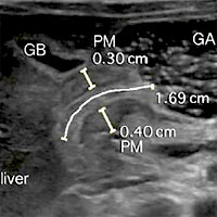 Immediate Diagnosis of Pyloric Stenosis with POCUS