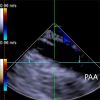 Implantation of Impella CP Left Ventricular Assist Device Under the Guidance of 3D Intracardiac Echocardiography