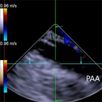 implantation-of-impella-cp-left-ventricular-assist-device-under-the-guidance-of-three-dimensional-intracardiac-echocardiography