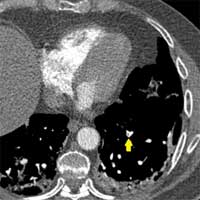 incidence-of-pulmonary-embolism-in-non-critically-ill-covid-19-patients