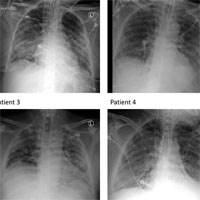 ACute resp Distress synd had increased dead space ventilation USMLE