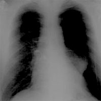 integration-of-lung-ultrasound-in-the-diagnostic-reasoning-in-acute-dyspneic-patients
