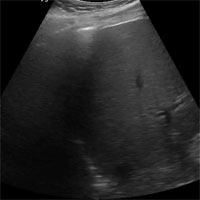 Is Lung Ultrasound an Option for COVID-19?
