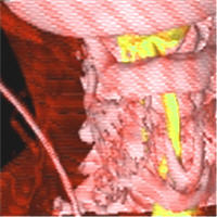 Laryngeal Radiation Fibrosis: A Case of Failed Awake Flexible Fibreoptic Intubation