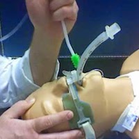 Clinical Impact of External Laryngeal Manipulation During Laryngoscopy on Tracheal Intubation Success in Critically Ill Children