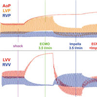 Left Ventricular Unloading and ECpella Role
