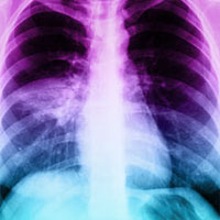 long-term-cognitive-impairment-after-hospitalization-for-community-acquired-pneumonia