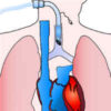 Lung and Diaphragm Protective Ventilation Guided by the Esophageal Pressure