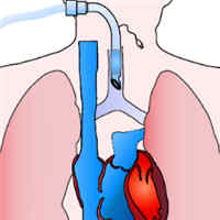 Lung and Diaphragm Protective Ventilation Guided by the Esophageal Pressure