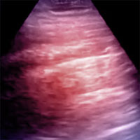 Lung Ultrasonography Features of COVID-19 Pneumonia