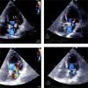 LV Overloading Identified by Critical Care Echocardiography is Key in Weaning‑induced Pulmonary Edema
