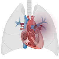 management-of-pulmonary-embolism-in-the-icu