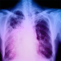 Metabolic Profiles in Community-Acquired Pneumonia