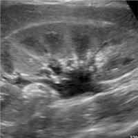 Multi-Organ Point-Of-Care Ultrasound in AKI
