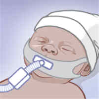 Nasal High-Flow Therapy during Neonatal Endotracheal Intubation