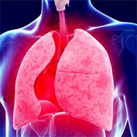 natural-history-of-copd-exacerbations-in-a-general-practice-based-population-with-copd