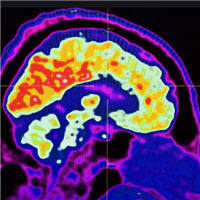 Neurological Complications Acquired During Pediatric Critical Illness