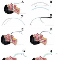 New Device for Intubation Through a Laryngeal Mask Airway