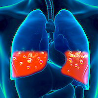 New Guideline Aids in Diagnosing Idiopathic Pulmonary Fibrosis