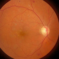 noninvasive-retinal-analysis-for-cardiovascular-profiling-of-patients-with-copd
