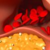 Oral PCSK9 Inhibitor Could Help Reduce LDL-C by 60%