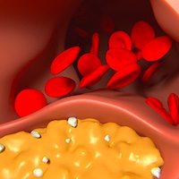Oral PCSK9 Inhibitor Could Help Reduce LDL-C by 60%