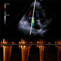 Estimate Artery Occlusion Pressure in Critically Ill Patients Under Mechanical Ventilation Using Doppler Echocardiography