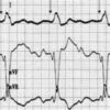 Percussion Pacing – An Almost Forgotten Procedure for Hemodynamically Unstable Bradycardias?