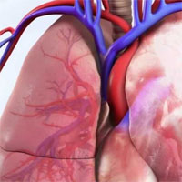 PERTs Aim to Disentangle Gordian Knot of Acute Pulmonary Embolism
