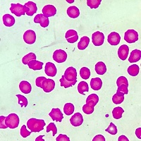 plasmic-score-role-in-the-management-of-thrombotic-thrombocytopenic-purpura