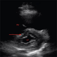Ultrasound Probe: POCUS for Flexor Tenosynovitis
