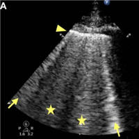 Point-of-Care Ultrasound (POCUS) and COVID-19