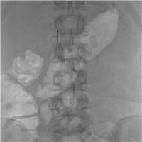 preoperative-vena-cava-filter-placement-in-recurrent-cerebral-fat-embolism-following-traumatic-multiple-fractures