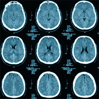 Presenting Characteristics Associated With Outcome in Children With Severe TBI