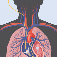 Pulmonary Artery Catheter Use and Mortality in the Cardiac ICU