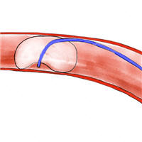 pulmonary-artery-catheterization-in-patients-with-cardiogenic-shock