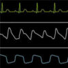 Pulse Oximetry Waveform: A Non-invasive Physiological Predictor for the ROSC During CPR