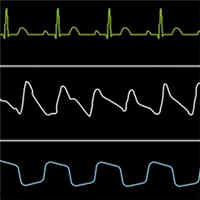 pulse-oximetry-waveform-a-non-invasive-physiological-predictor-for-the-rosc-during-cpr