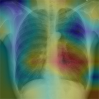 Radiologist-Level Pneumonia Detection on Chest X-Rays with Deep Learning