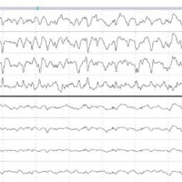 rapid-bedside-evaluation-of-seizures-in-the-icu-by-listening-to-the-sound-of-brainwaves