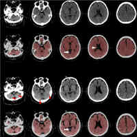rapidly-progressive-brain-atrophy-in-septic-icu-patients