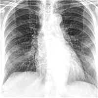 Retrospective Analysis of Chest X-ray Severity Scoring System of COVID-19 Pneumonia